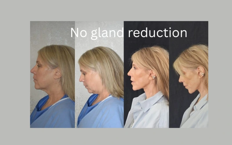 No gland reduction