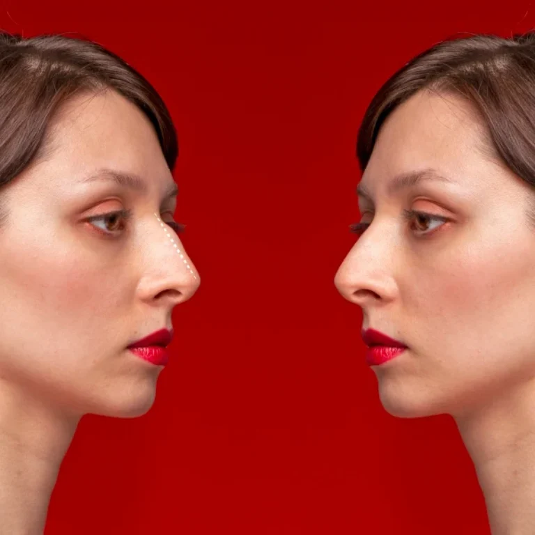 Facial Fat Transfer vs Facelift.jpg