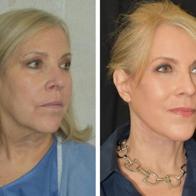 Deep Plane Facelift