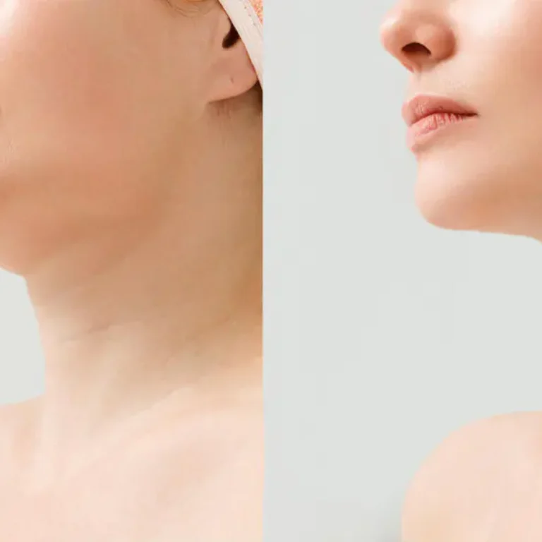 platysmaplasty vs neck lift.jpg