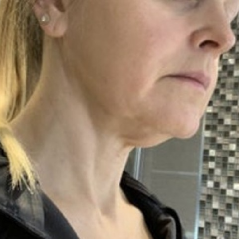 tbt-facelift-patient-before-surg