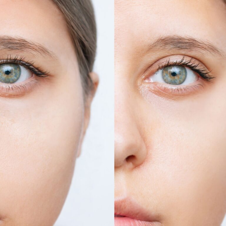 young-woman-s-face-with-drooping-upper-eyelid-before-after-blepharoplasty-plastic-surgery