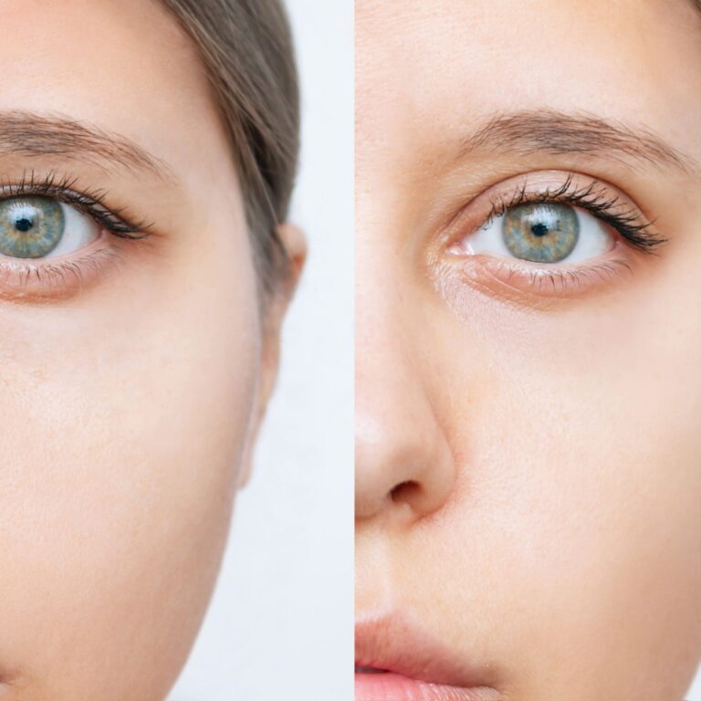 young-woman-s-face-with-drooping-upper-eyelid-before-after-blepharoplasty-plastic-surgery